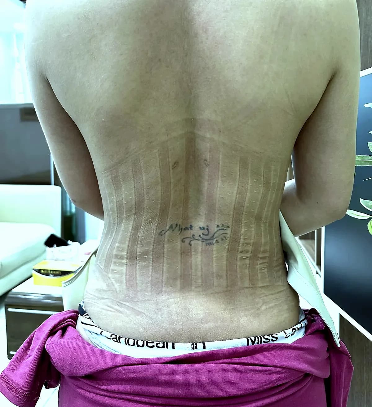 After surgery