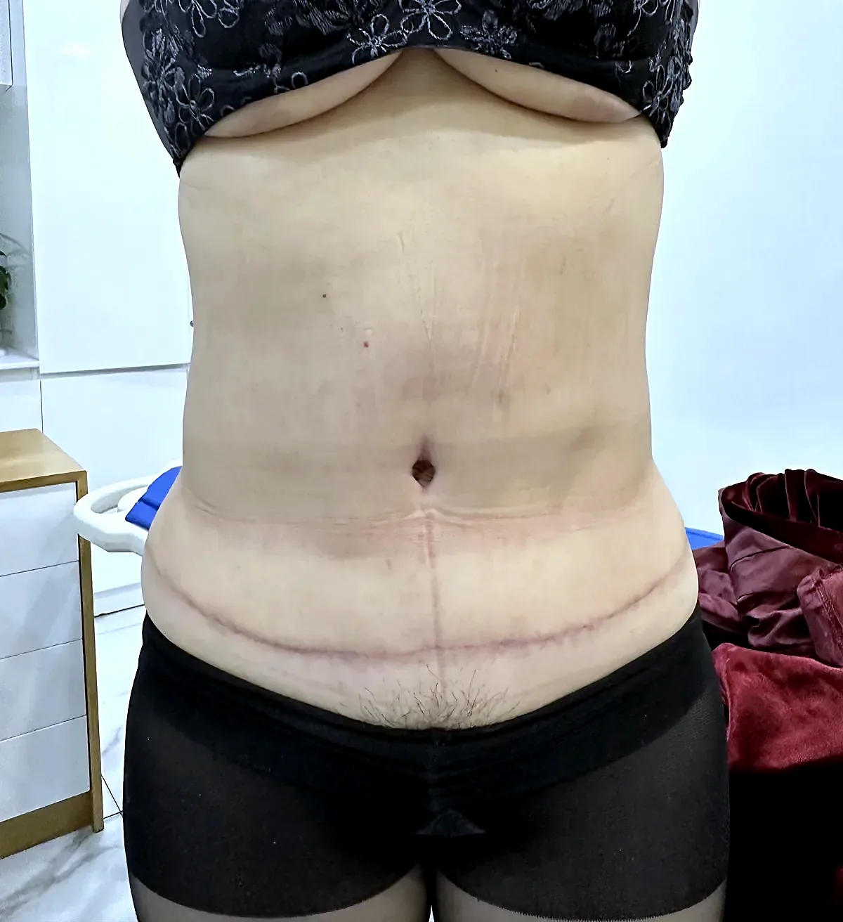Before surgery