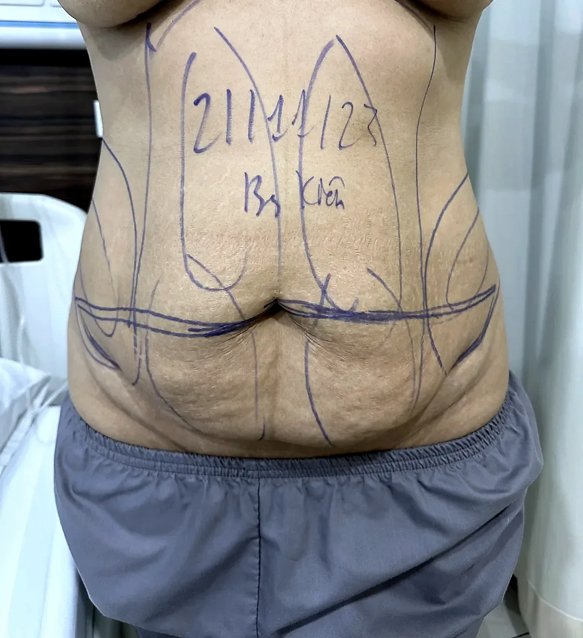 Before surgery