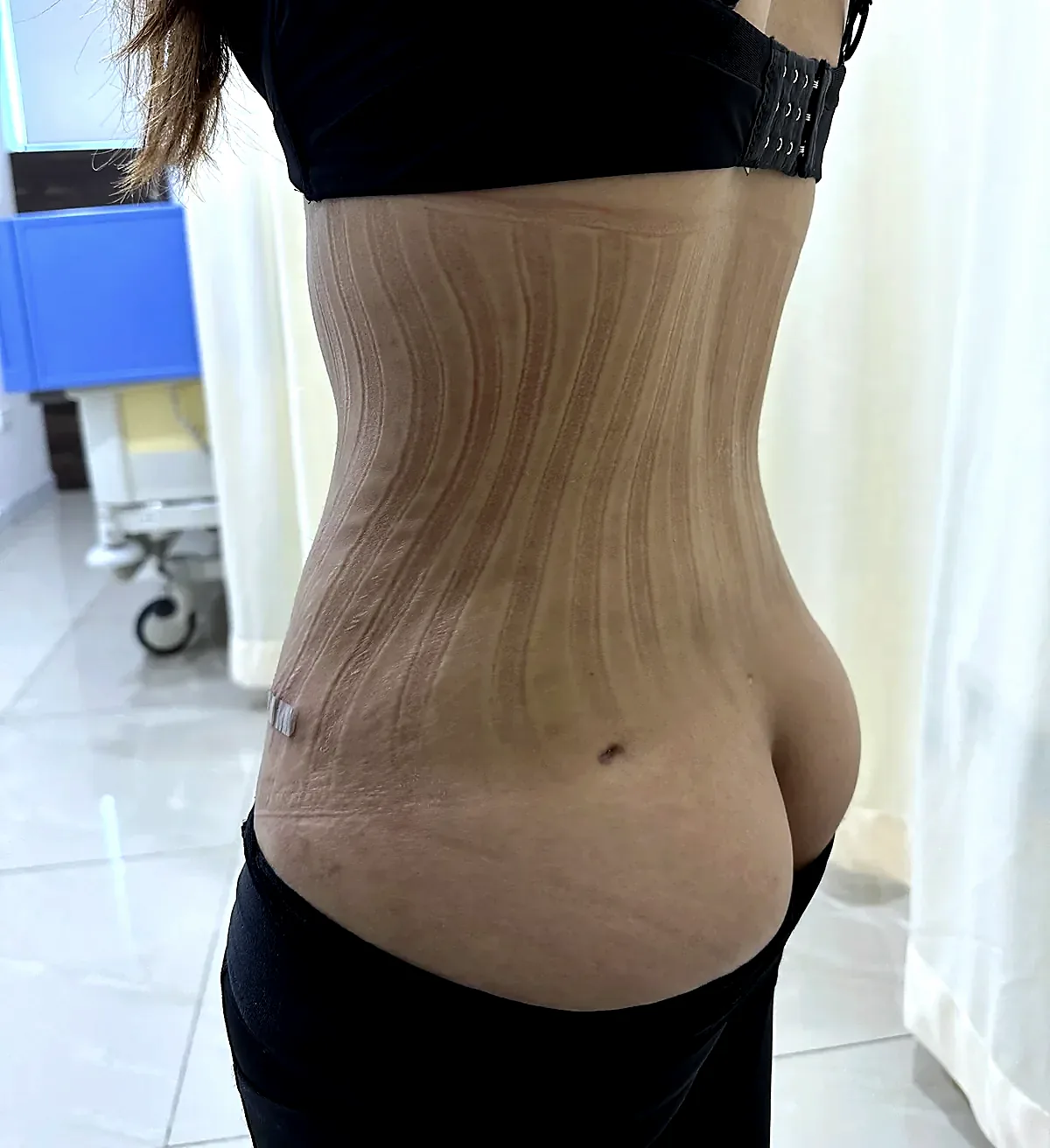 After surgery