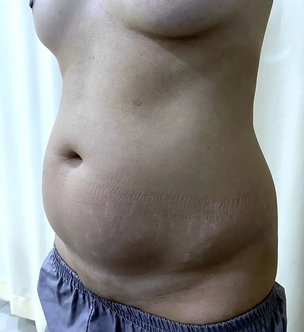 Before surgery