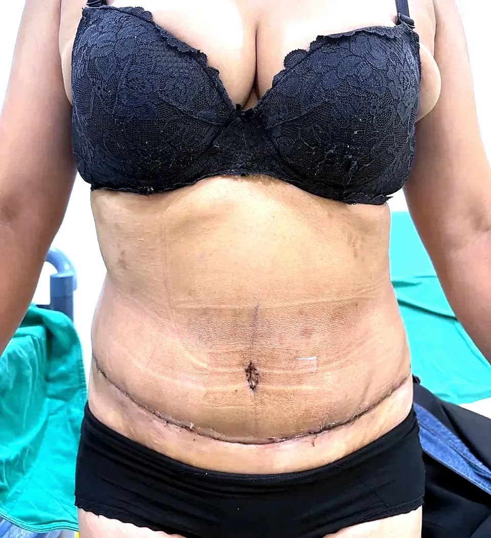 After surgery