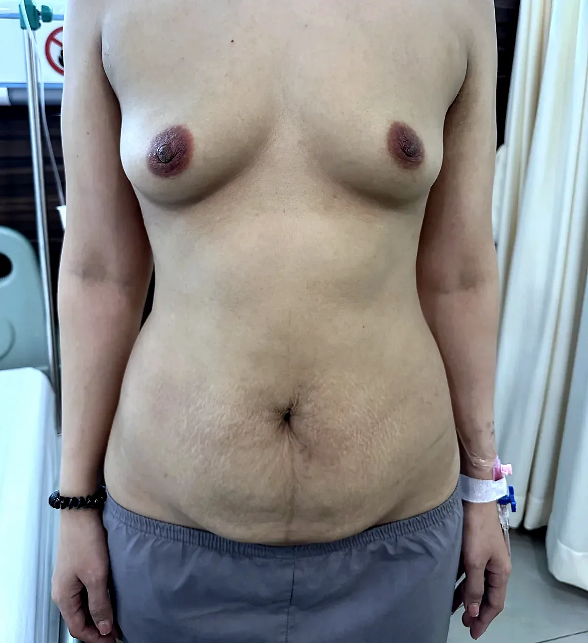 Before surgery