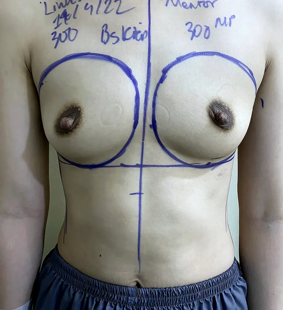 Before surgery