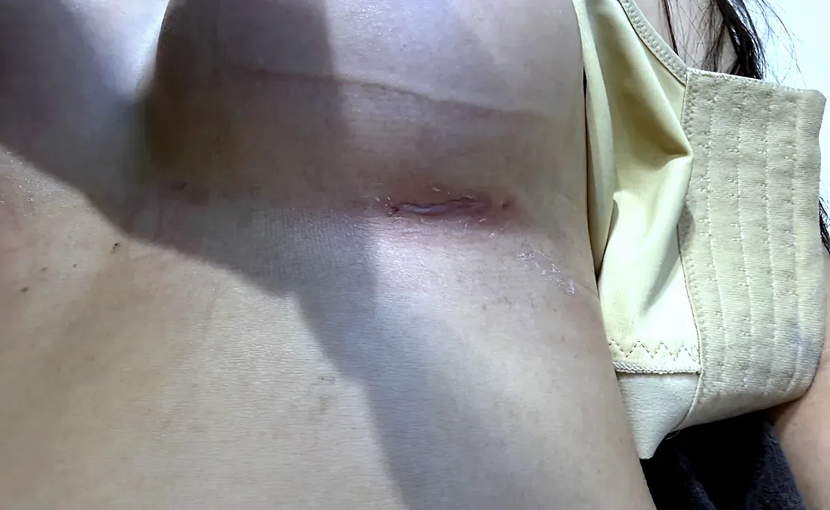 After surgery