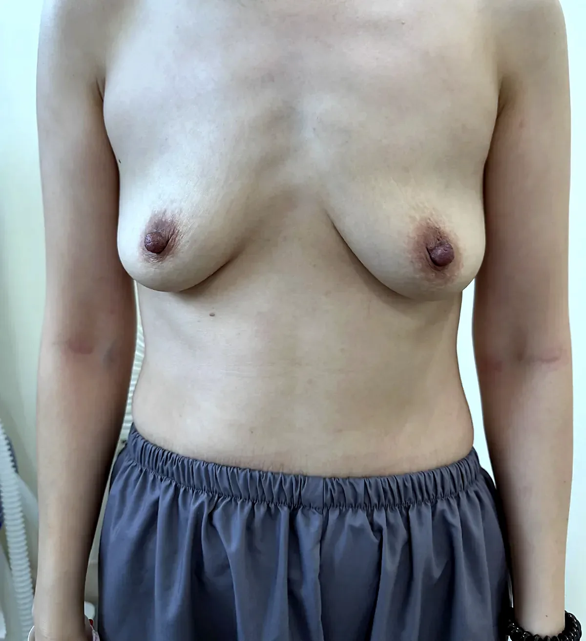 After surgery