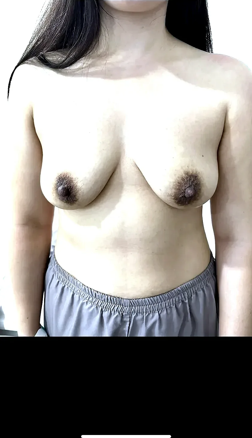 After surgery