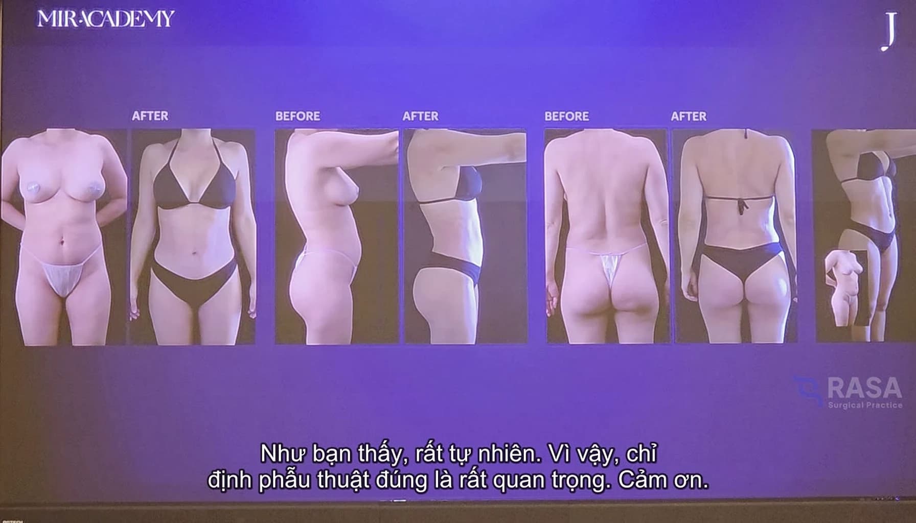 Clinical waist-reduction case frame from Dr Mir body contouring training