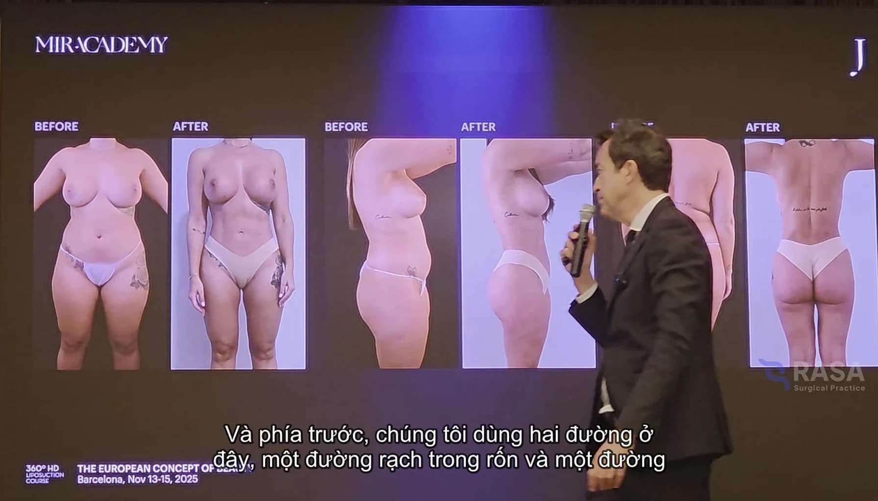 Dr Mir lecture frame showing clinical before and after analysis in body contouring